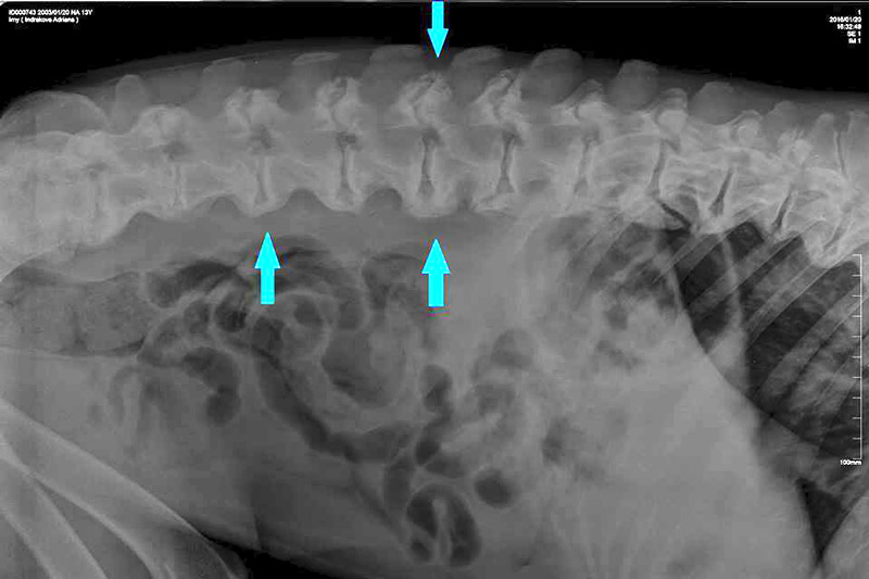 Spondylóza Spondylóza